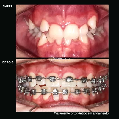 Aparelho Ortodôntico Piraquara
