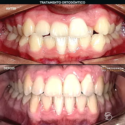 Aparelho Ortodôntico Piraquara