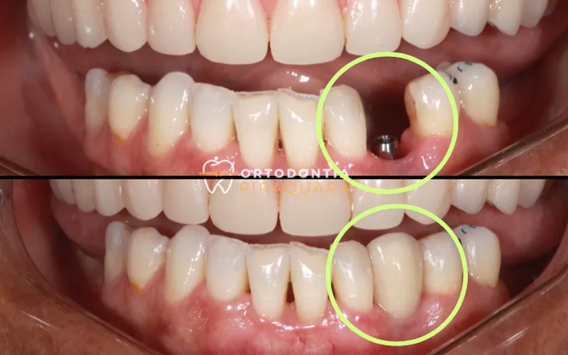 Antes e depois de implante dentário