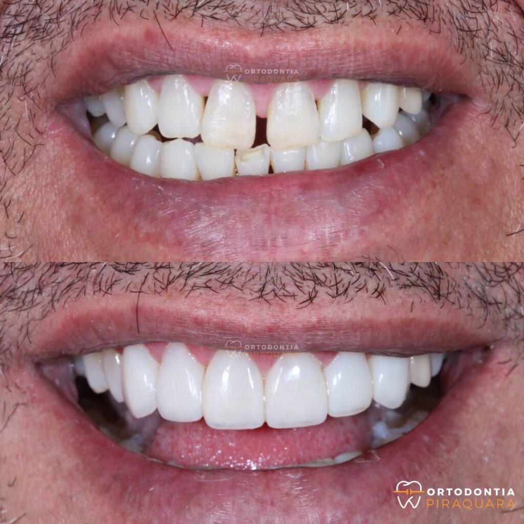 Antes e depois de facetas em resina em Piraquara